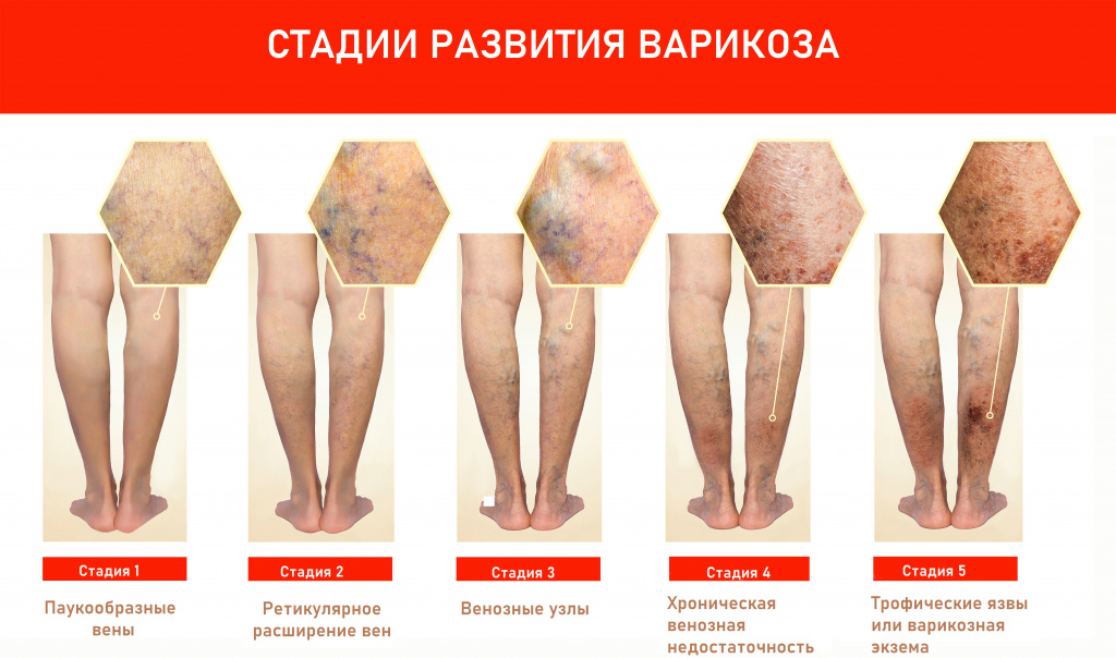Лечение трофических язв и незаживающих ран в клинике ФлебоЛайф в Санкт-Петербурге