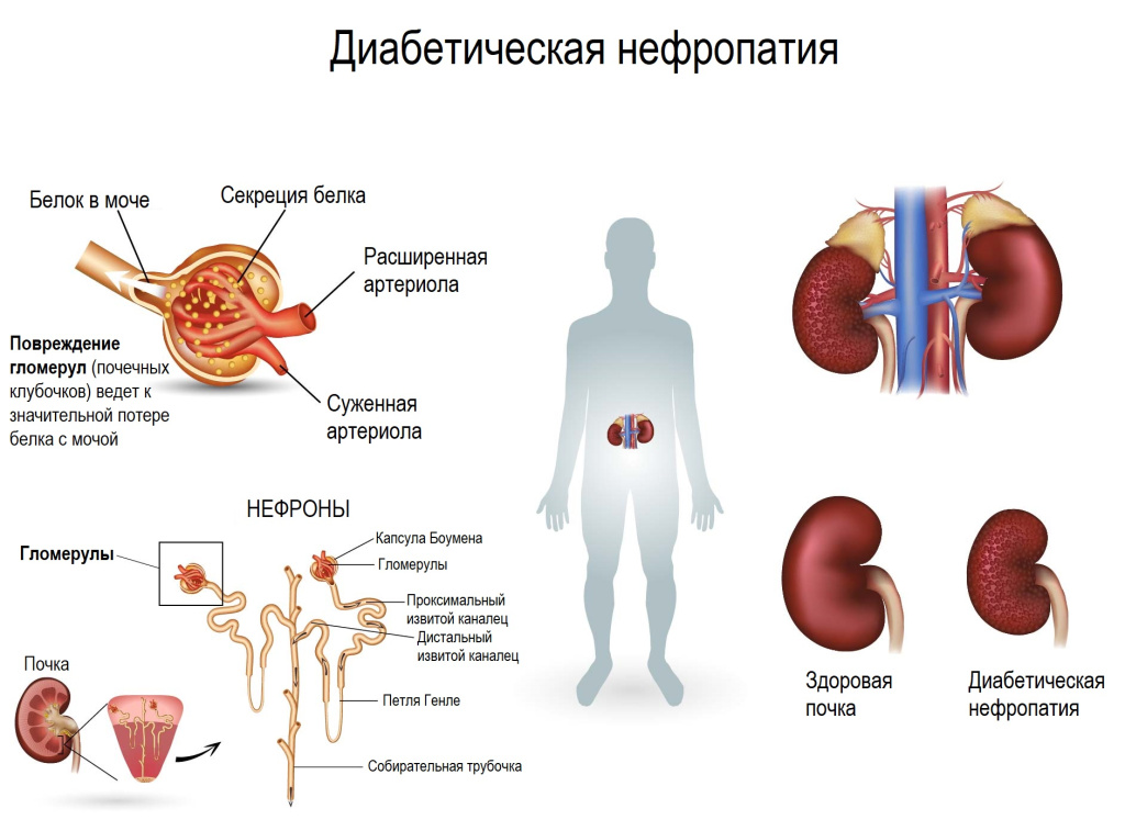 Половые расстройства у мужчин при сахарном диабете (лекция)