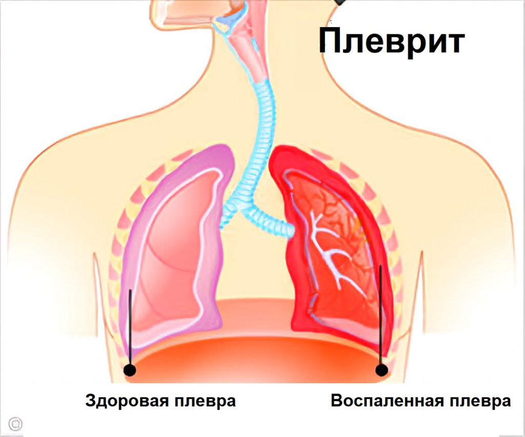 Боль в грудной клетке: причины, симптомы - Центр доктора Бубновского