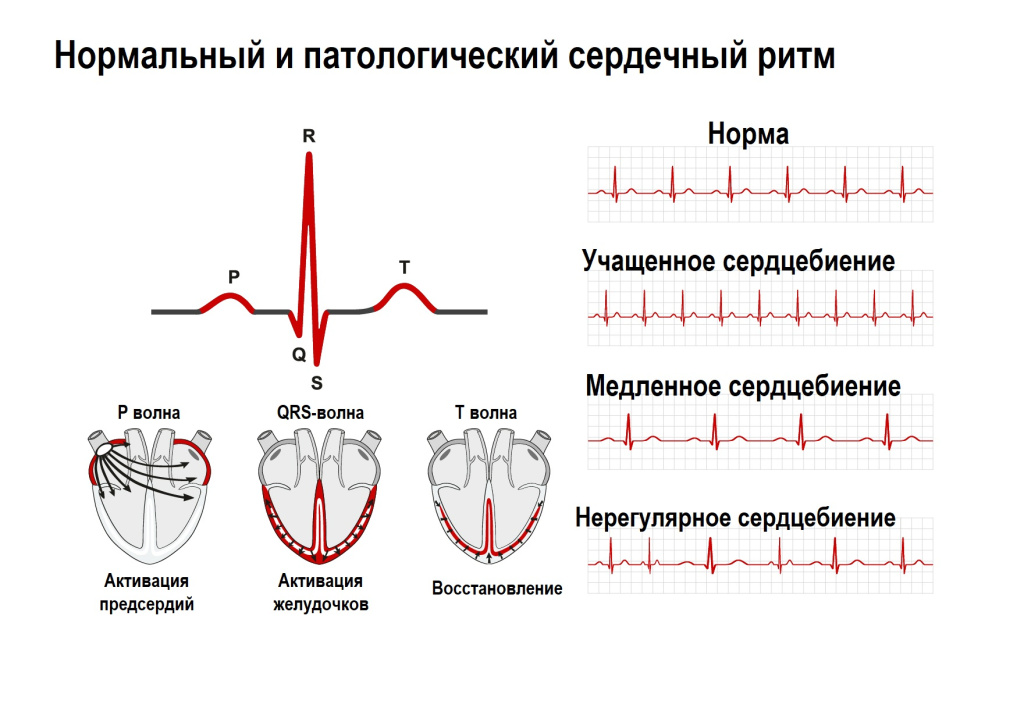 Аритмия сердца - причины, симптомы и лечение патологии