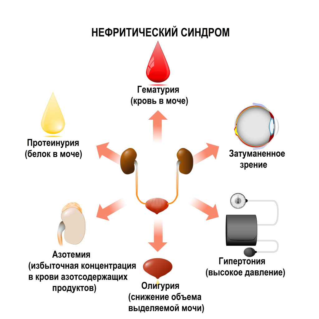 Нефритический синдром - причины появления, при каких заболеваниях  возникает, диагностика и способы лечения