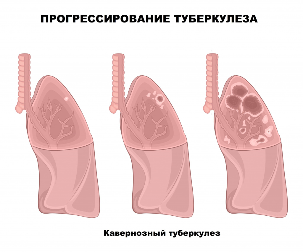 Туберкулез: стадии, симптомы, диагностика, лечение