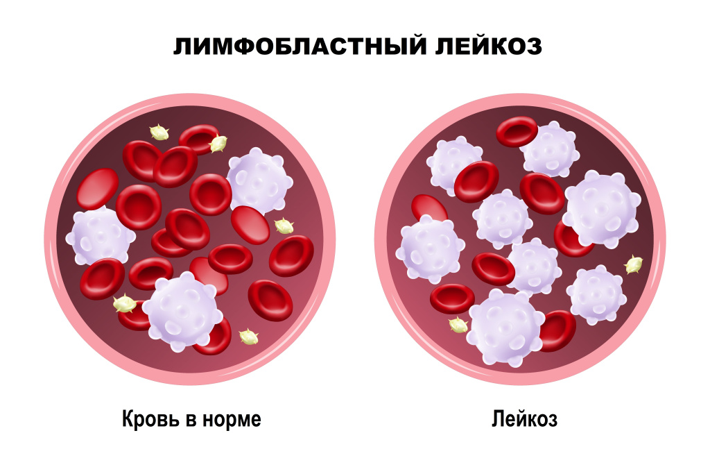 Лимфобластный лейкоз анализы