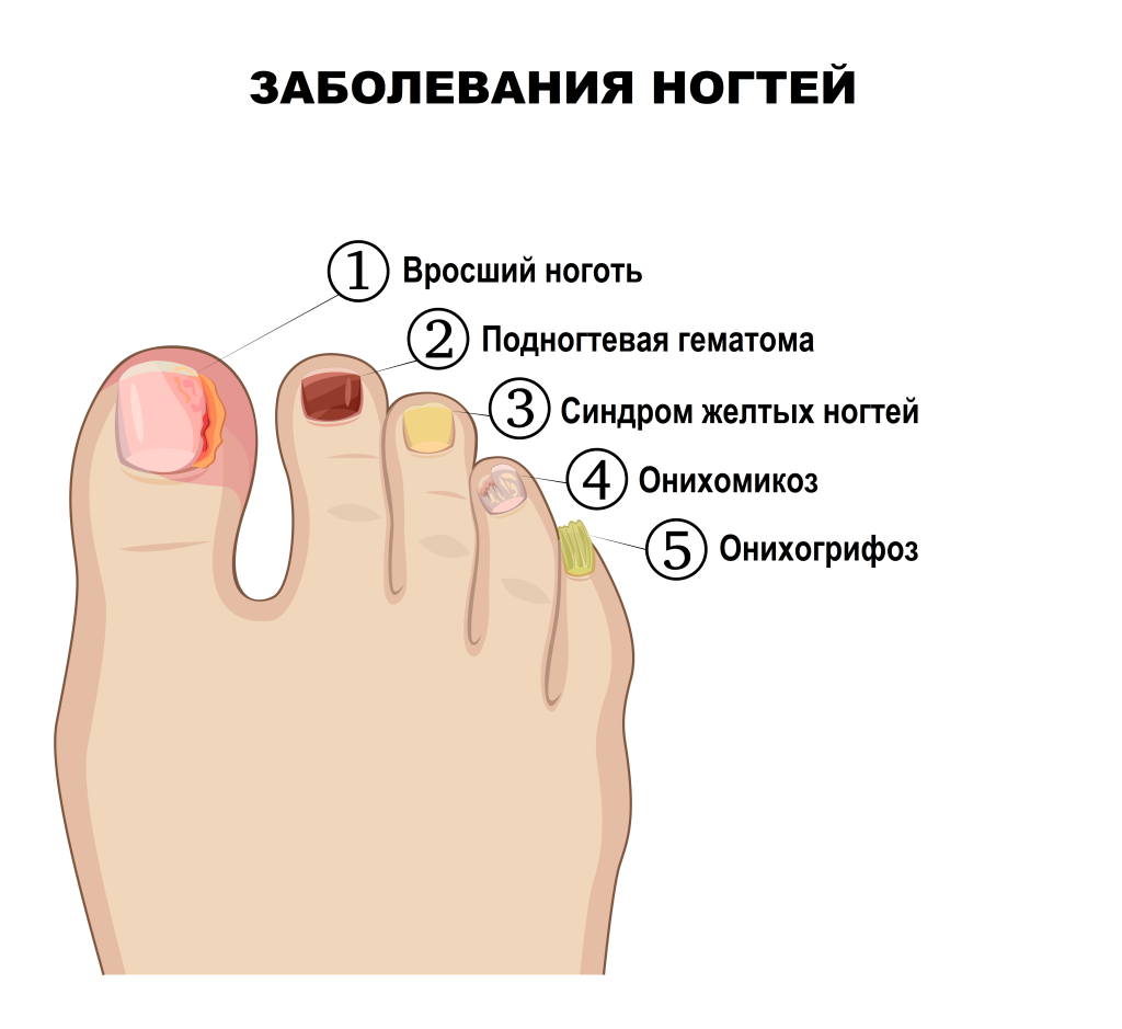 Изменился цвет ногтя на ноге – что это, как лечить?