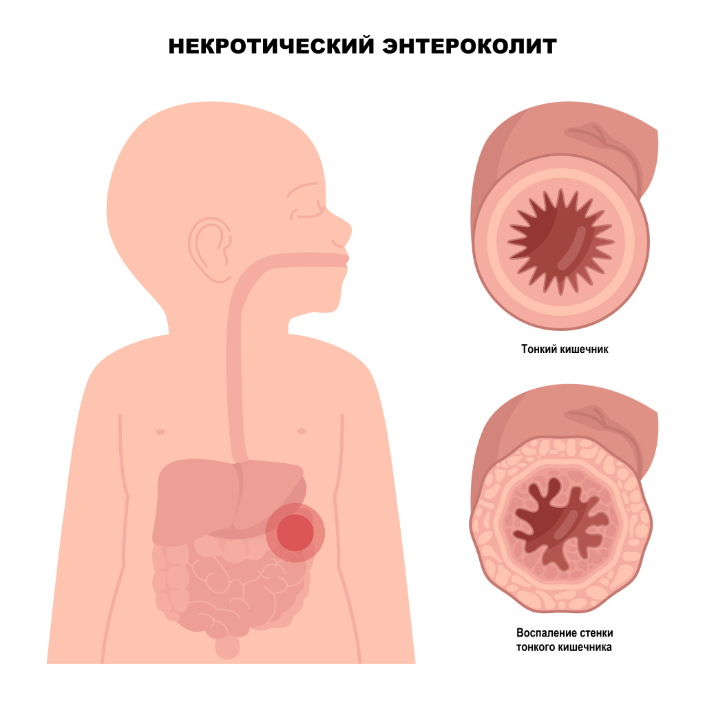 Некротический энтероколит.jpg