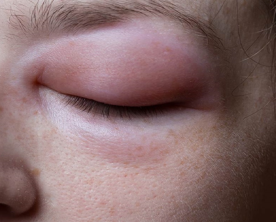 Воспаление века глаза: признаки и лечение