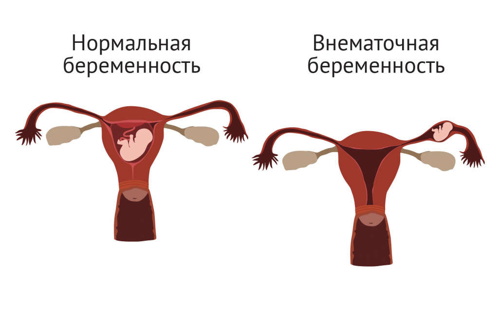 Боль в правом боку при беременности: резкая, ноющая, тянущая, колющая, под ребрами, при ходьбе