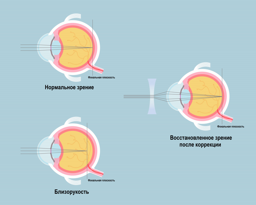 Коррекция зрения.jpg