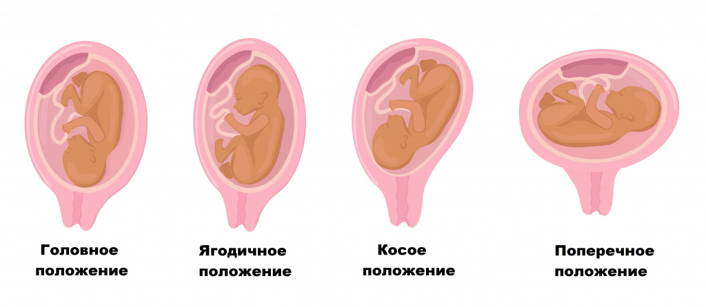 Какие бывают положения плода в утробе матери