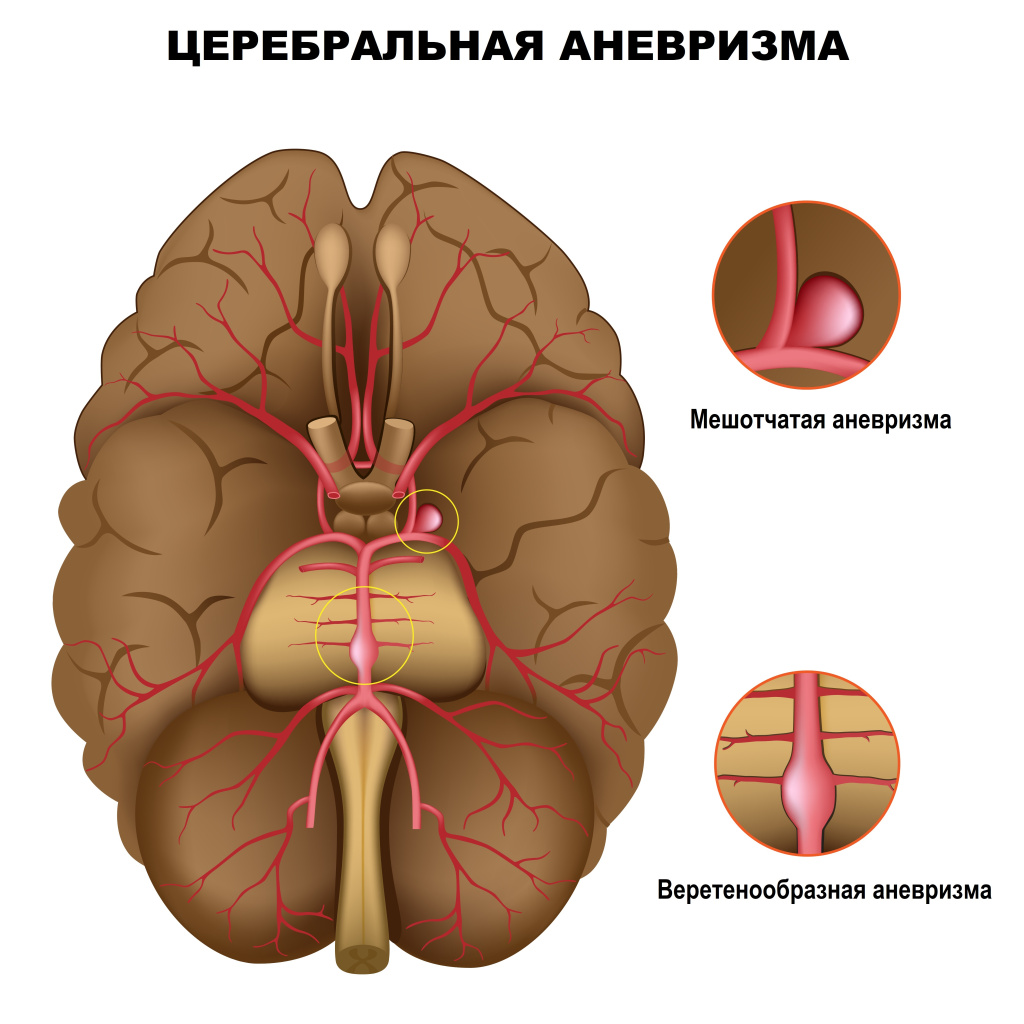 Аневризма.jpg