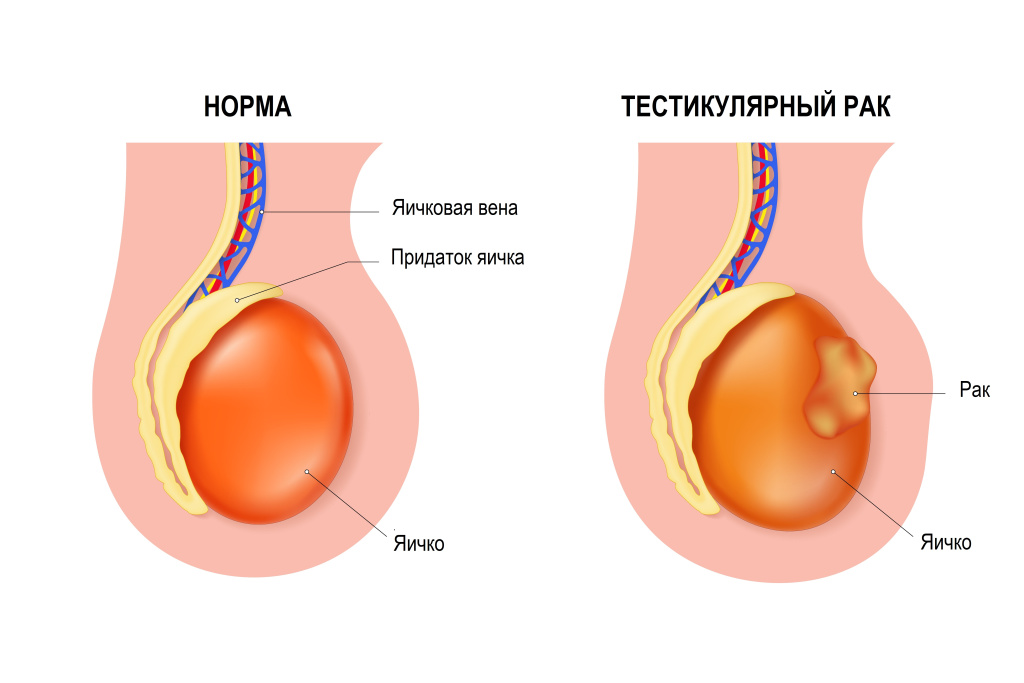 Рак яичка.jpg