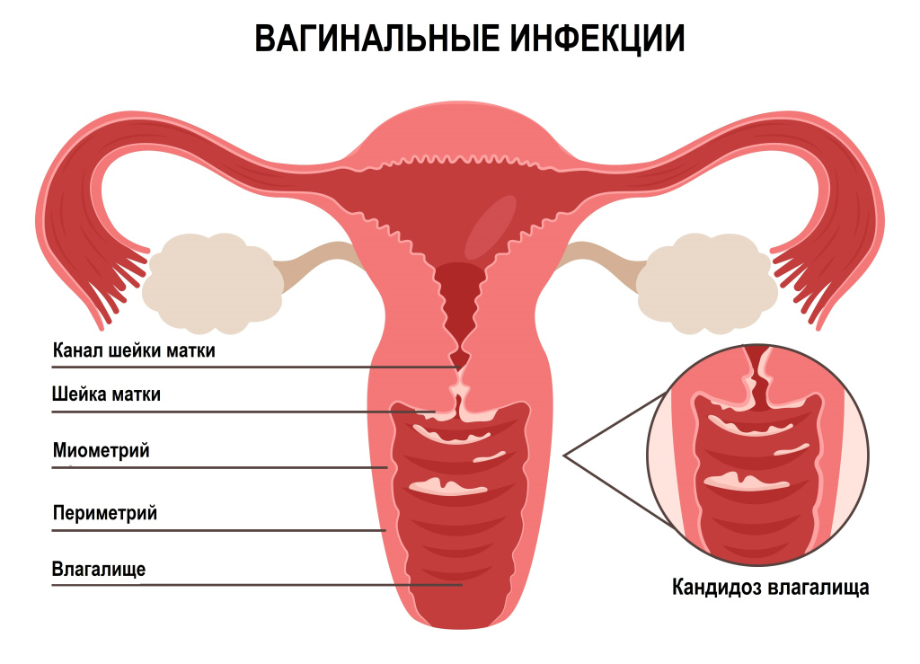 Микроскопическое исследование отделяемого мочеполовых органов женщин (микрофлора), 3 локализации