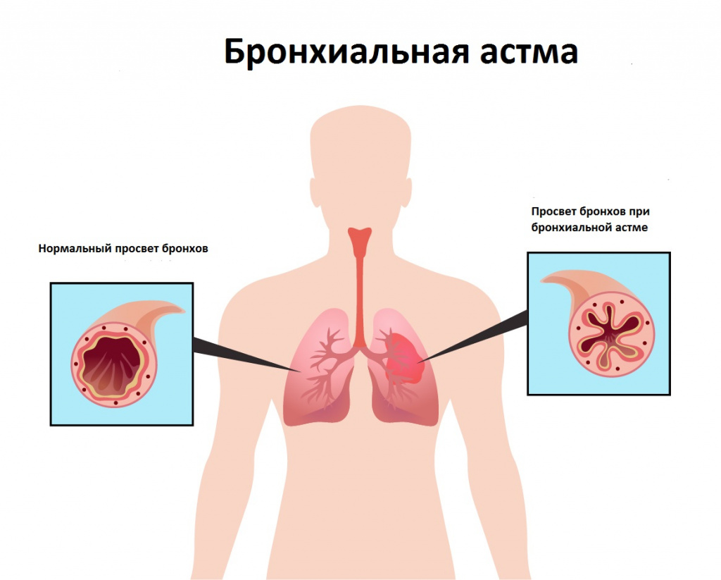 Чем опасен сухой кашель и что с ним делать? | steklorez69.ru