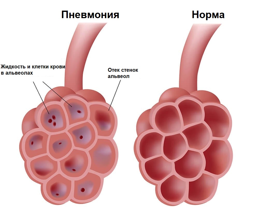 Диагностика и лечение кашля при заболеваниях органов ЖКТ в Москве