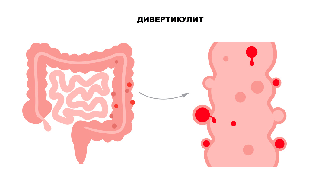 Дивертикул.jpg