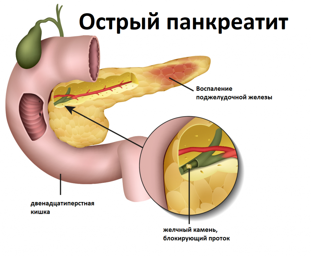 Диагностика и лечение патологий поджелудочной железы (Александров)