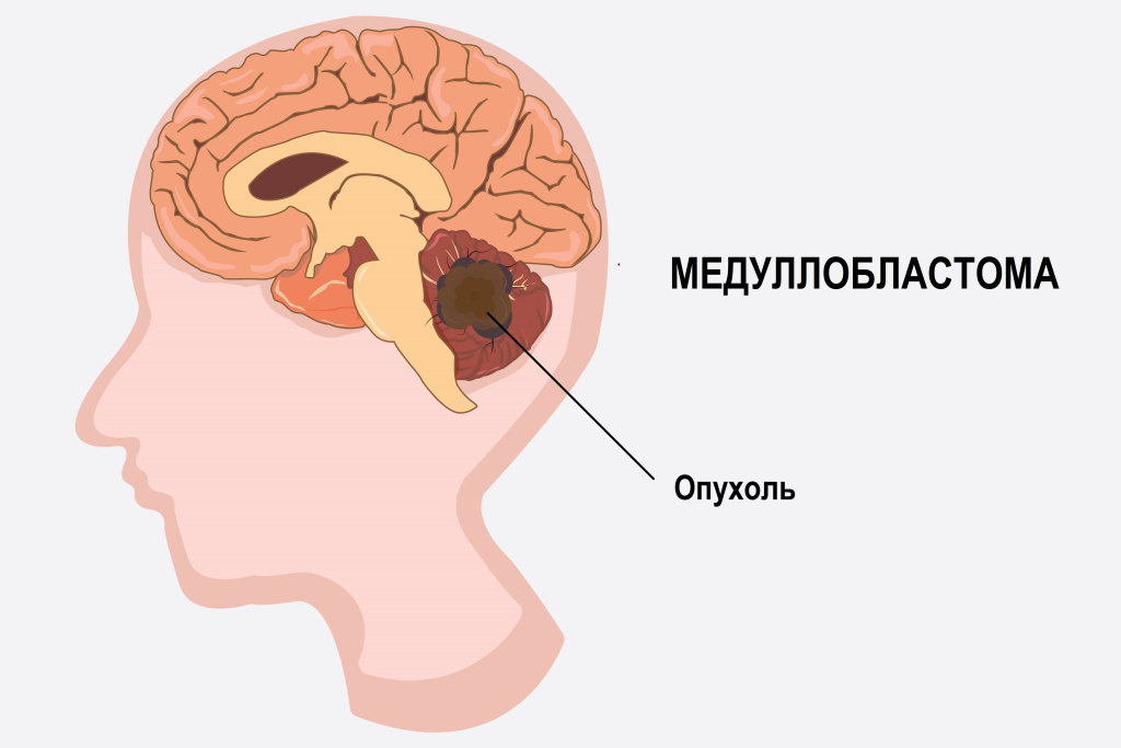 Медуллобластома.jpg