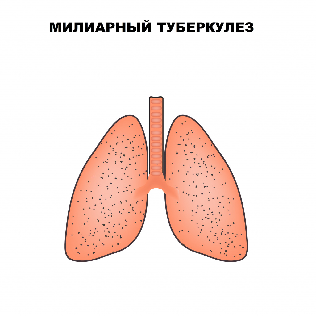 Туберкулез (ТБ) - Инфекционные болезни - Справочник MSD Профессиональная версия