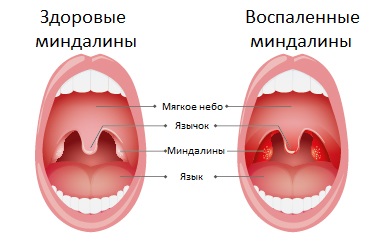 Воспаление миндалин анализ крови thumbnail