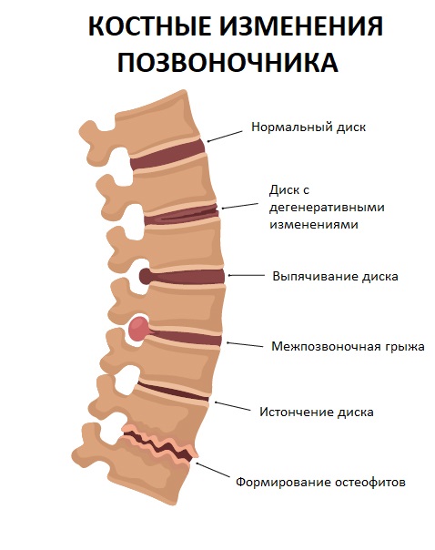 Остеохондроз шейного отдела позвоночника: симптомы и лечение в Одессе | Медицинский дом Odrex