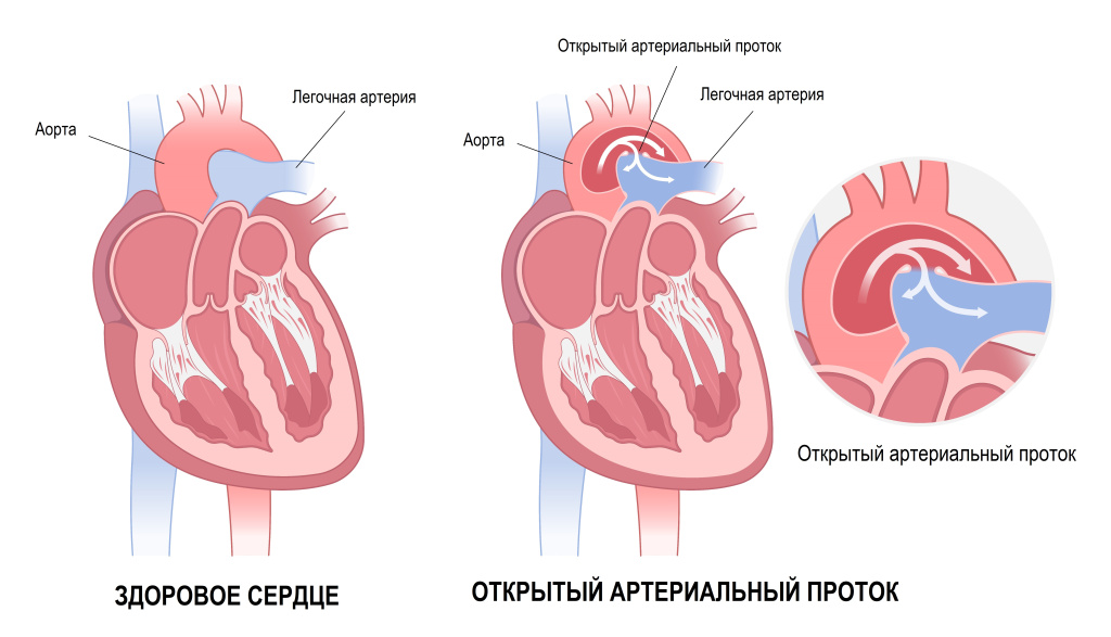 Артериальный проток.jpg