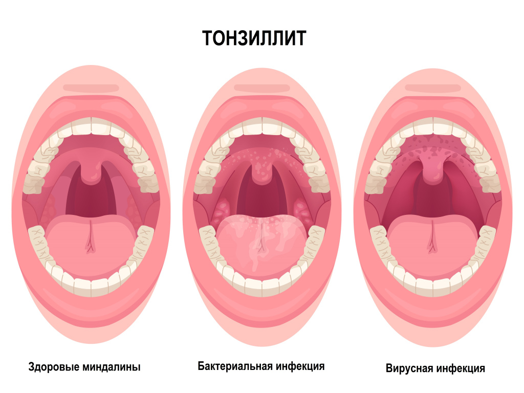 Острые заболевания горла и гортани