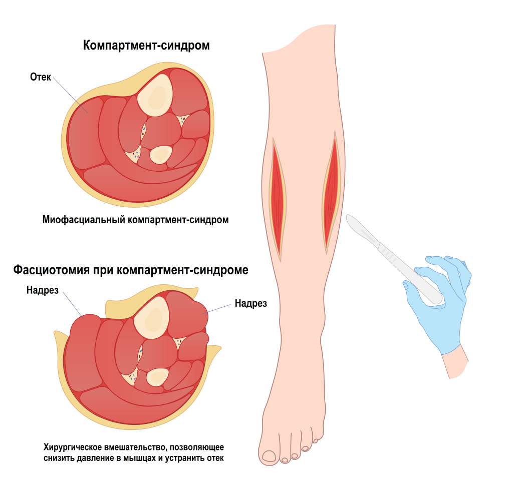 Компартмент-синдром.jpg
