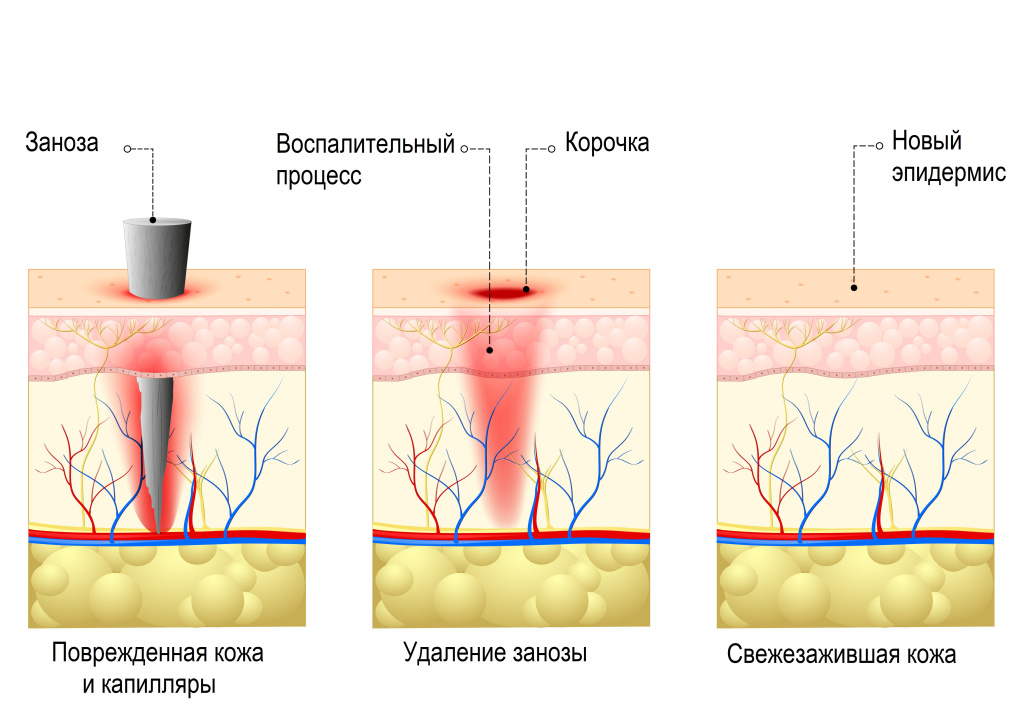 Заноза.jpg