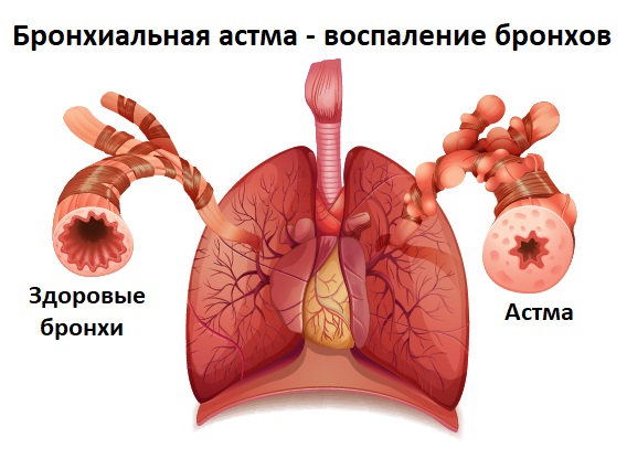 Как быстро вылечить кашель в домашних условиях: Рекомендации по лечению кашля | Microlife
