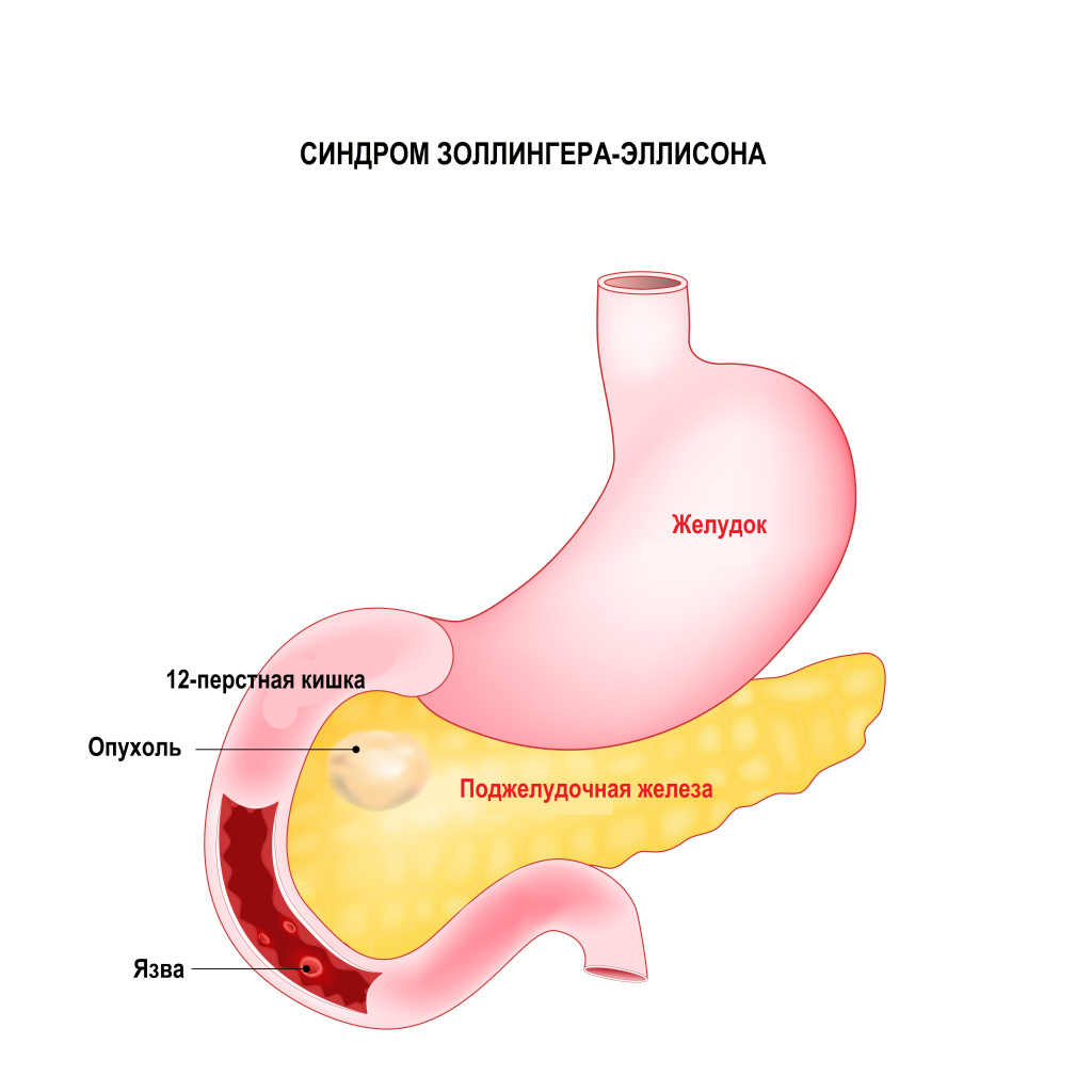 Синдром Золлингера.jpg