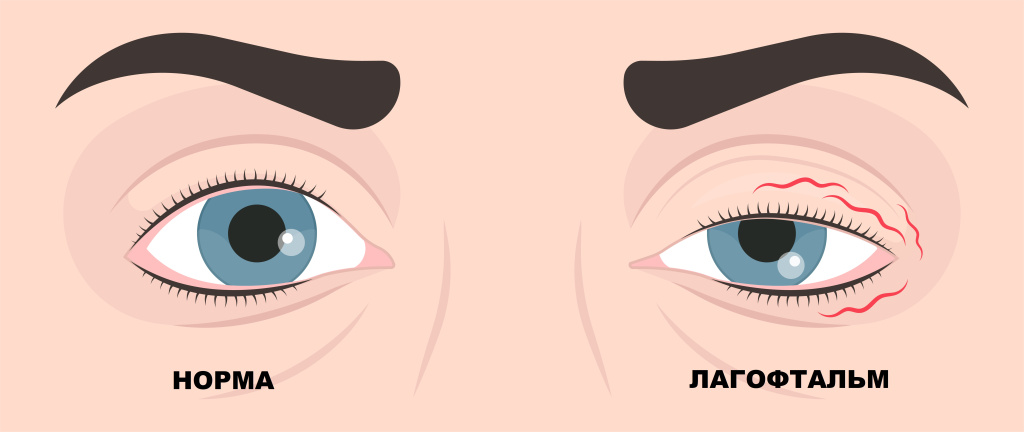 Причины нервного тика глаз