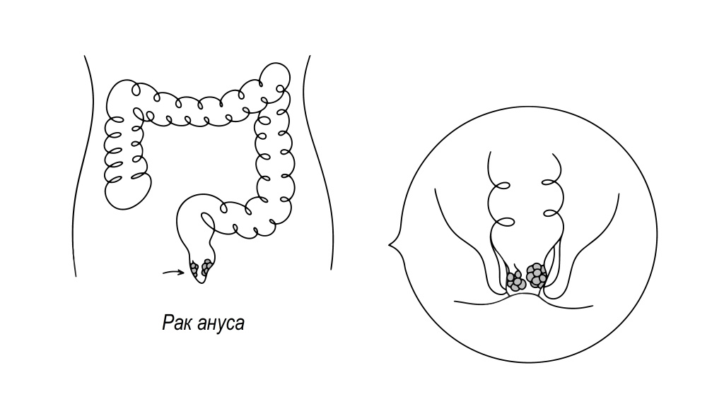 Рак анального канала.jpg