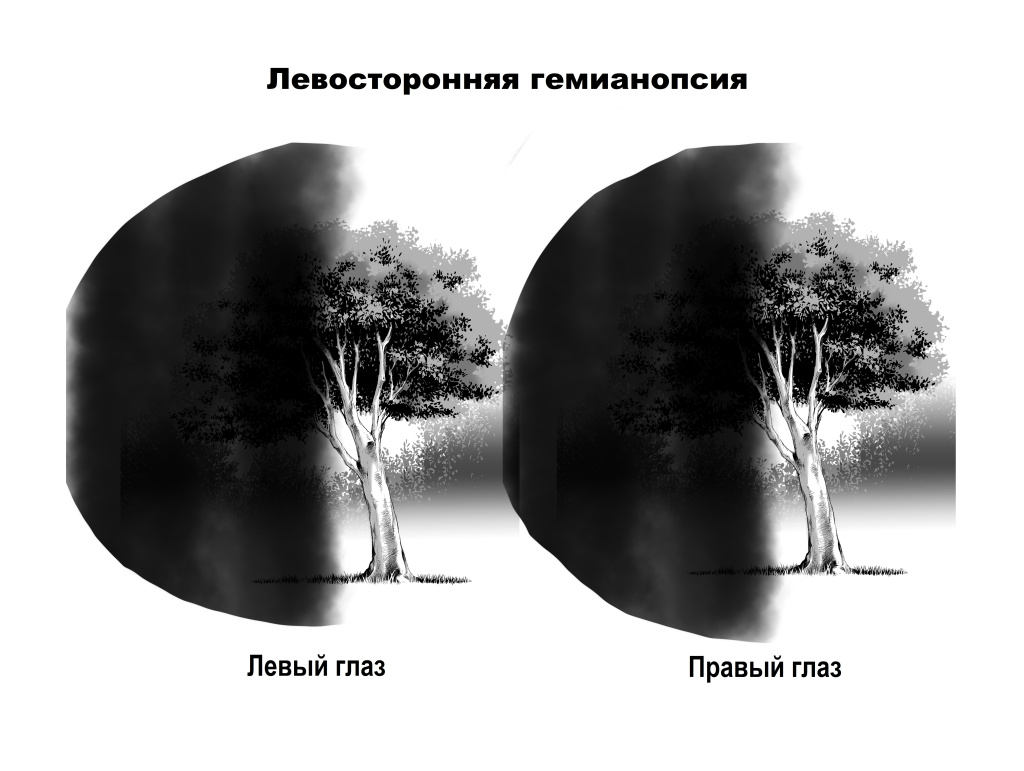 Левосторонняя гемианопсия.jpg