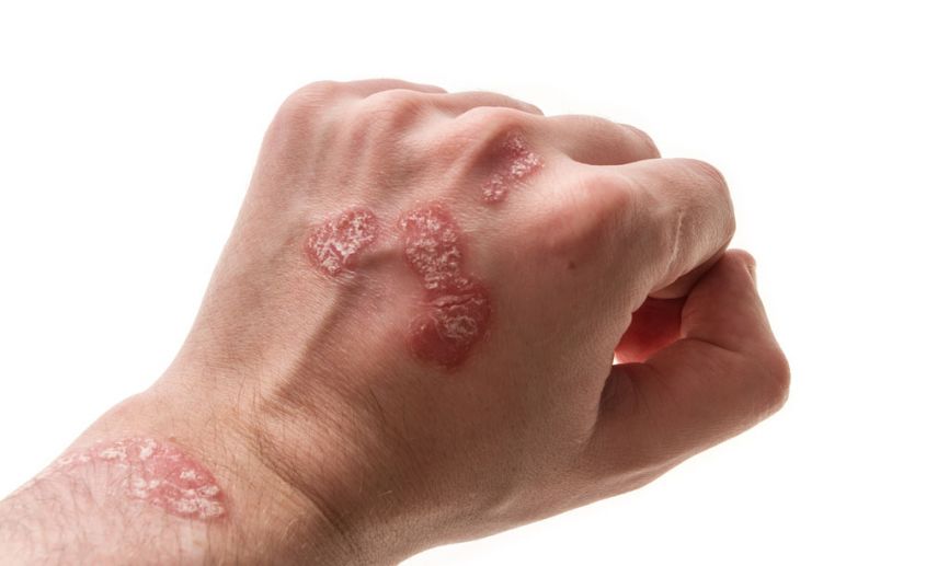 Почему появляется сыпь на коже: 5 самых распространенных причин