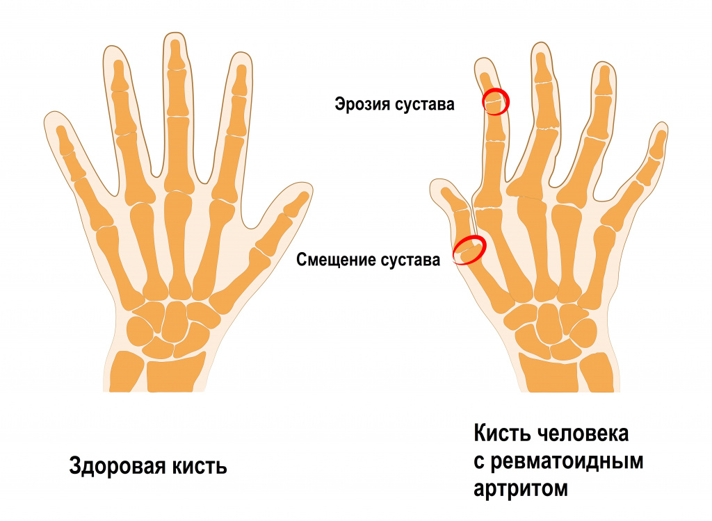 Эффективное лечение суставов рук