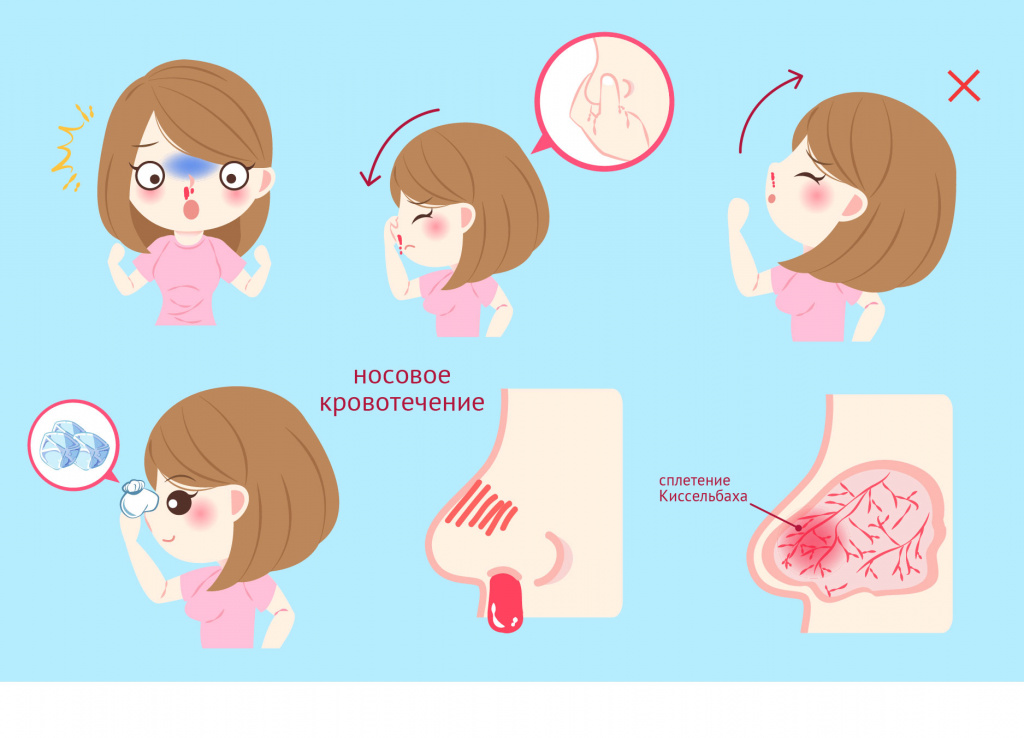 Носовые кровотечения - признаки, симптомы, причины, диагностика и способы остановки крови