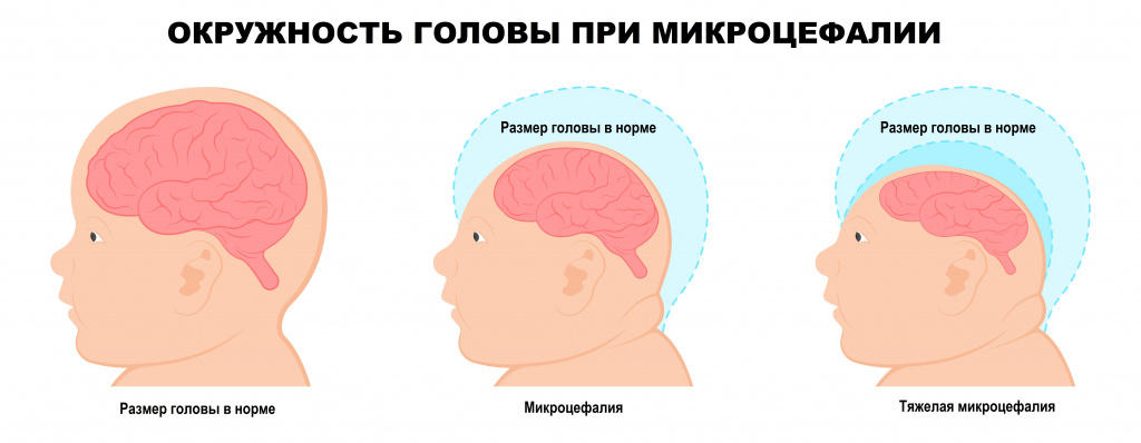Асимметрия лица, головы и черепа человека