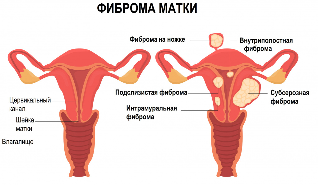 Опухоль матки: причины, симптомы, виды