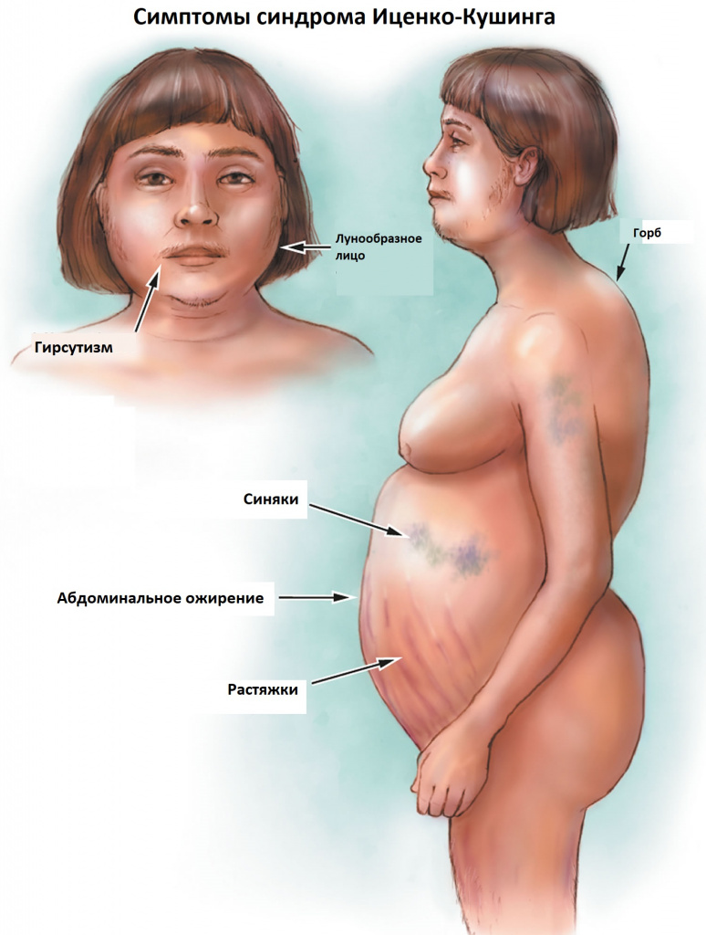 Синдром Иценко-Кушинга - причины появления, симптомы заболевания,  диагностика и способы лечения