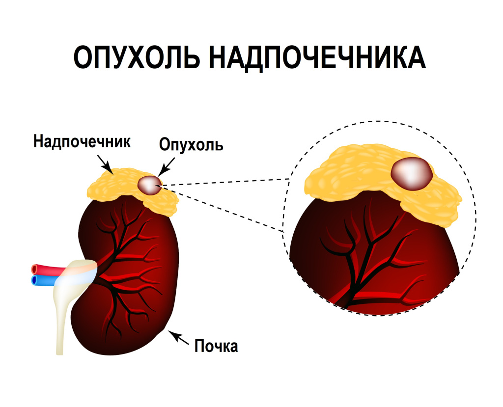 Аденома предстательной железы