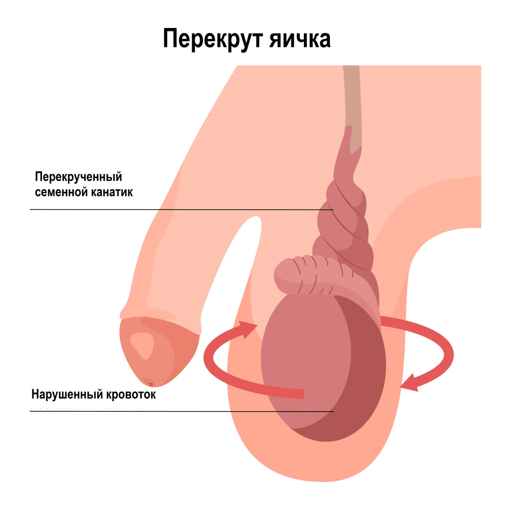 Перекрут.jpg