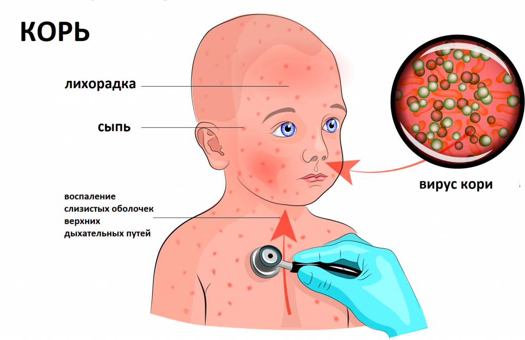 Лечение ОРВИ у детей в Киеве: лечение детской простуды и вирусов, цена в клинике Оксфорд Медикал