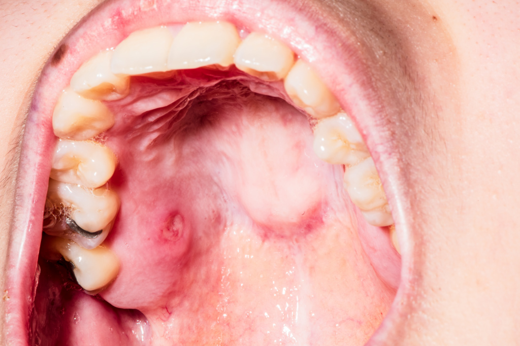 Гигиена полости рта при аллергическом стоматите