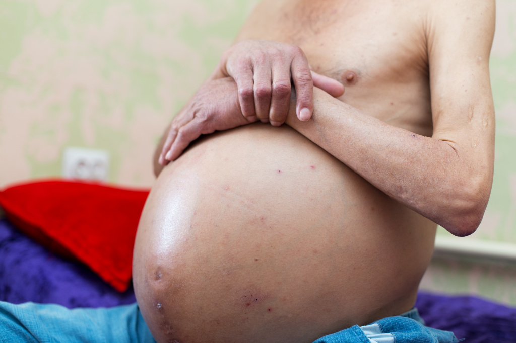 Вздутие живота при беременности на ранних сроках: причины, лечение метеоризма