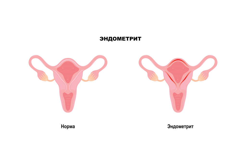 Эндометрит после родов.jpg