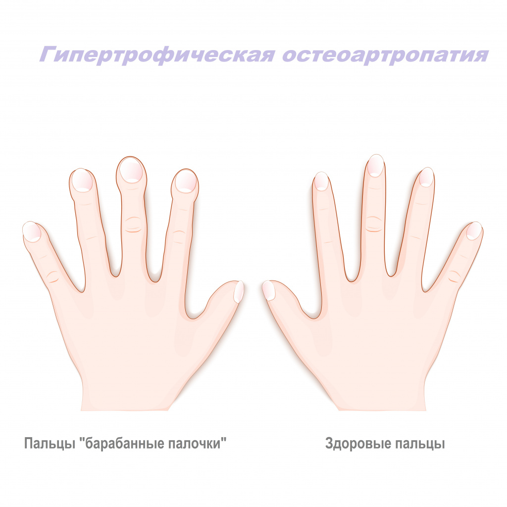 Причины скованности пальцев рук