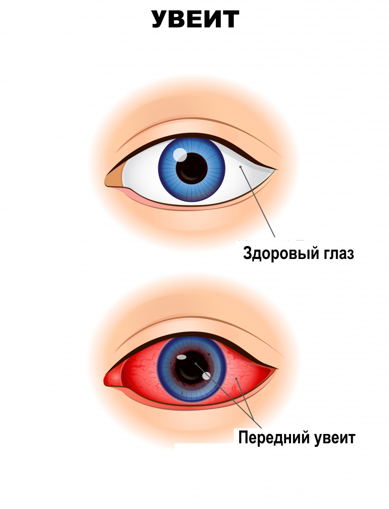 Лечение глазной боли