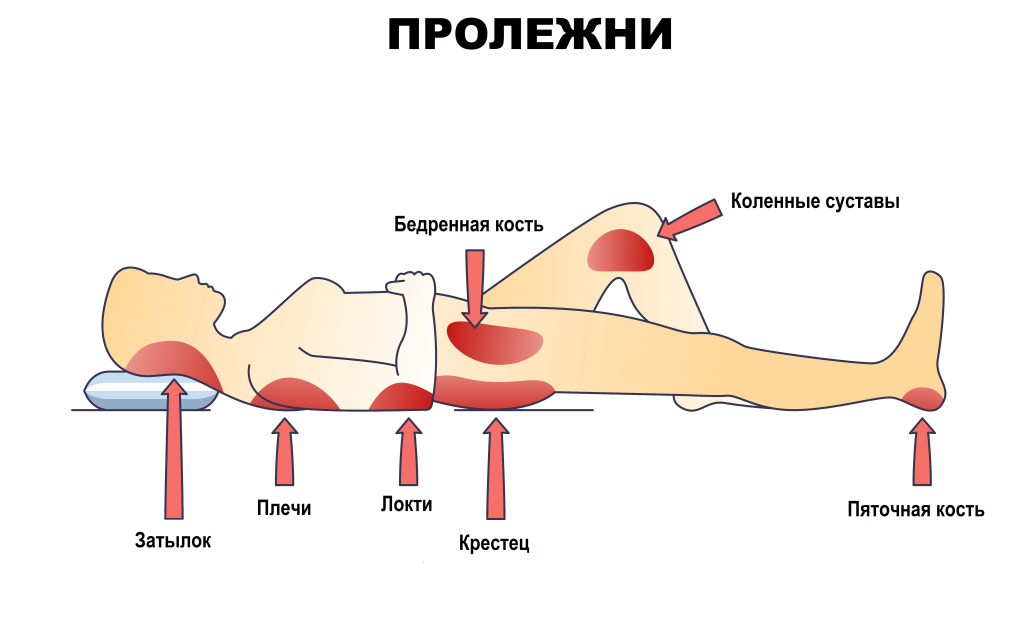 Пролежни.jpg