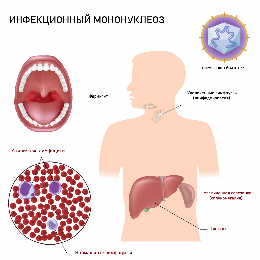 Симптомы мононуклеоза